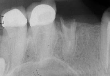 Praktyka _ Rekonstrukcje implantoprotetyczne Leczenie odcinka bocznego szczęki z zastosowaniem Encode Complete Restorative System Autor _ dr Christopher D.