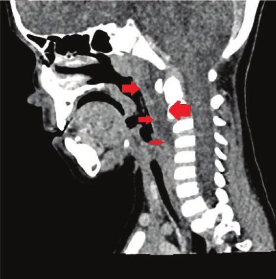 Seasonality in the incidence of deep neck space infections in children hospitalized in the Department of Pediatric Otolaryngology.