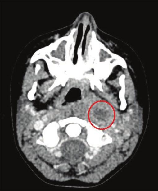 .. Introduction It may seem that in the era of antibiotic therapy, deep neck space infections occur incidentally.