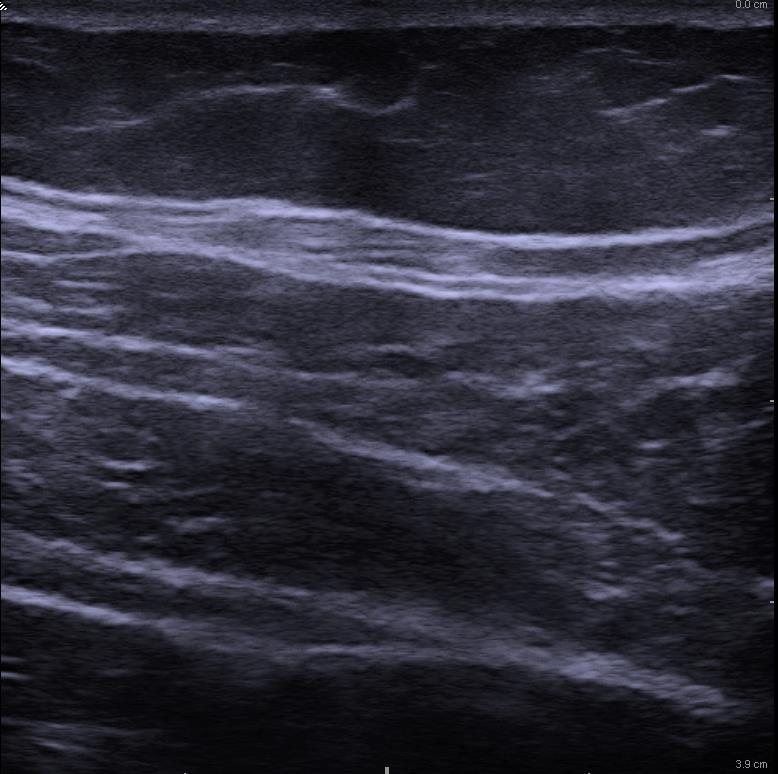 Quadratus Lumborum Block?