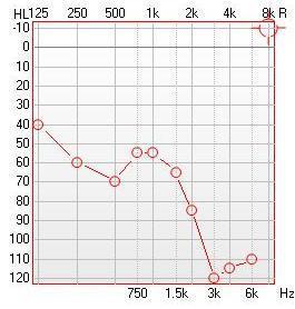 się o 15 db Zysk-3 db HL bez aparatów PTA-70 db HL Poziom