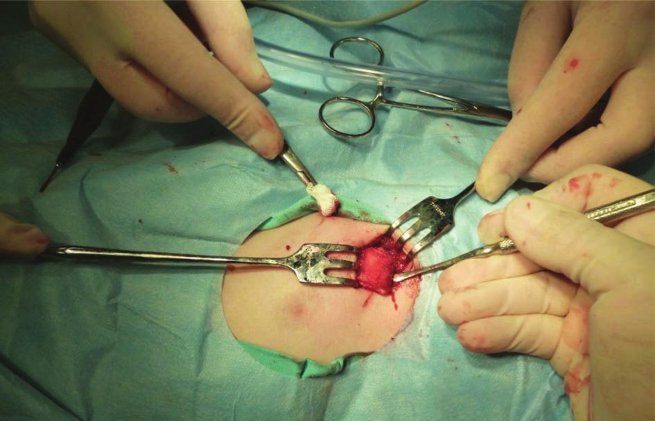 Assessment of efficacy of laryngotracheal reconstruction with autogenous rib cartilage graft Ocena skuteczności zabiegów rekonstrukcyjnych krtani z użyciem wszczepu chrzęstnego Fig. 1.