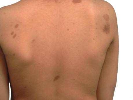 Postaci alleliczne Zespół Watson a(ws) Rodzinna postać rdzeniowa neurofibromatozy(nfsp)