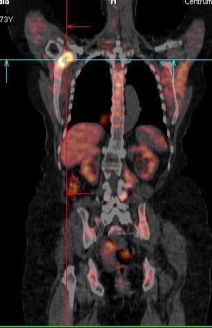 18 F FDG PET / CT uwidacznia naciek nowotworowy - pierwotny