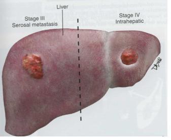 Rak jajnika- przerzut pod torebkę i do wątroby Pod torebkę III