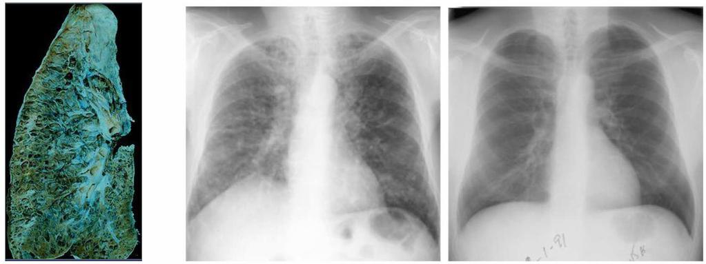 Przykład 7 Śródmiąższowe choroby płuc ocena zwłóknień Powstają na skutek uszkodzenia wyściółki pęcherzyków płucnych, co prowadzi do