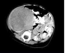 Przykład 11 Wspomaganie diagnostyki guzów nerki Tomografia CT guza Wilmsa prawej nerki u