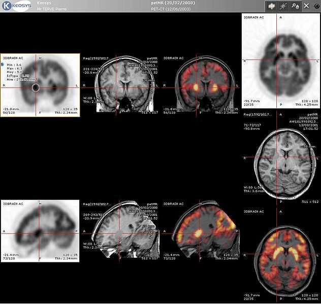 Przykład 12 Wspomaganie diagnostyki obrazów PET/MRI Zdjęcia mózgu