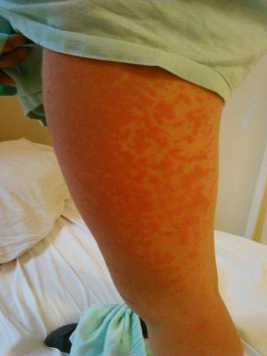 Ambulantne bola preliečená Augmentínom. Serologicky bola taktiež vylúčená infekčná mononukleóza, avšak zachytená pozitivita adenovírusov zo séra.