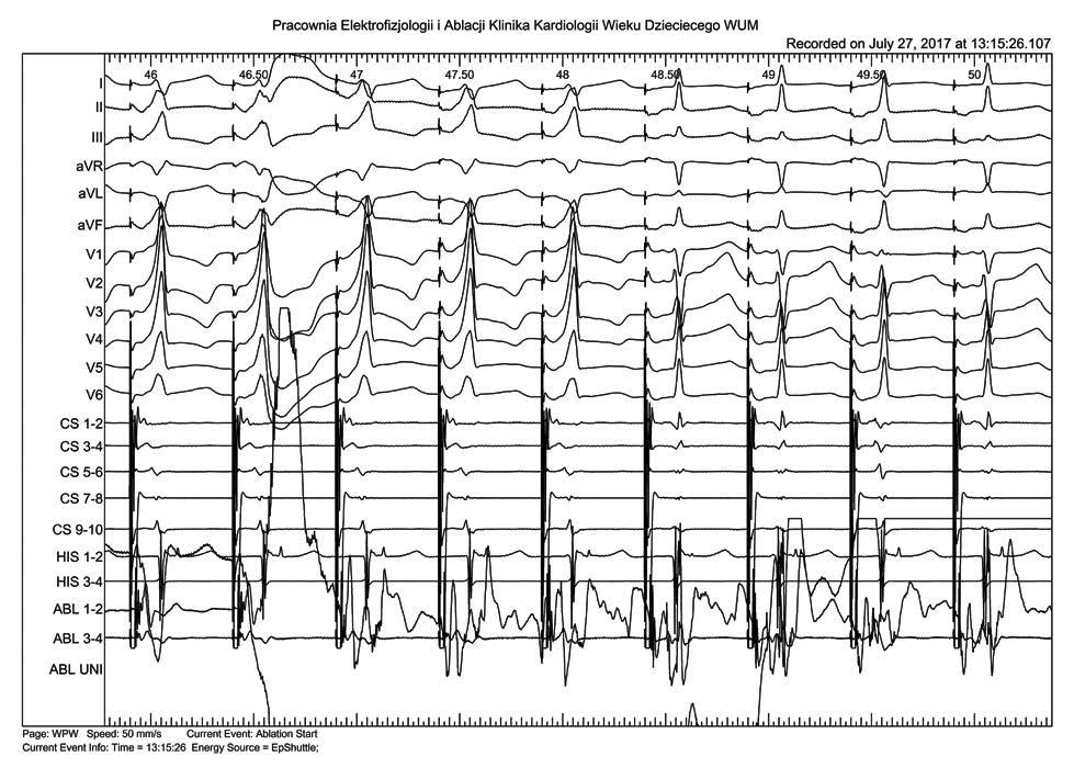 Zespół WPW u 11-letniej dziewczynki Ryc. 2. Zapis częstoskurczu, który wystąpił w czasie badania EPS Ryc. 4. 12-odprowadzeniowy zapis EKG po zabiegu ablacji, bez cech preekscytacji Ryc. 3.