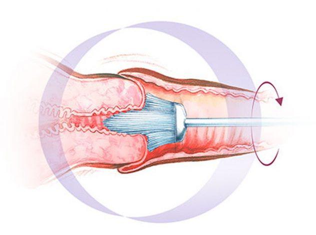 źrodło: http://m.ocdn.eu/ badanie to nie jest badaniem inwazyjnem W przypadku nieprawidłowego wyniku badania cytologicznego, zostaniesz skierowana na dalszą diagnostykę: KOLPOSKOPIA Ocena cz.
