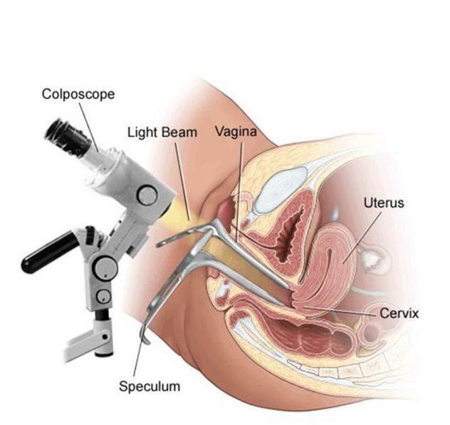 legenda do ilustracji Speculum wziernik Light beam źródło światła uterus macica cervix szyjka macicy vagina pochwa cilposcope kopolskop