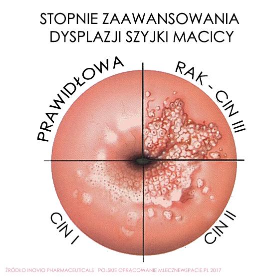 CIN najczęściej pojawia się w strefie pomiędzy tarczą szyjki