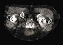 artykuł naukowy / scientific paper radiologia / radiology 11 Algorytmy redukcji artefaktów Skaner TK Brilliance Big Bore ma detektor obrazowy oraz ścieżkę przetwarzania danych skonstruowane tak, aby