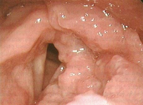 Rak płaskonabłonkowy (carcinoma