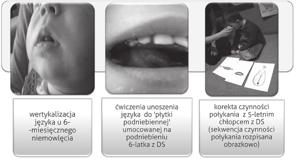 Holistyczna opieka logopedyczna nad małym dzieckiem 83 ustnej, zgodnie z fizjologią połykania.