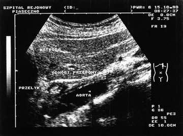 Pol J Radiol, 2006; 71(2): 31-41 The diagnostic value of transabdominal sonography... Badanie żołądka Badanie usg żołądka nie wymaga specjalnego przygotowania.
