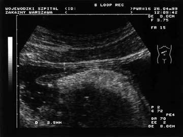 Original Article Pol J Radiol, 2006; 71(2): 31-41 i występowanie w usg warstw rzekomych tzw. interface, wywołanych powstaniem echa między dwiema powierzchniami warstw różniących się gęstością [9].