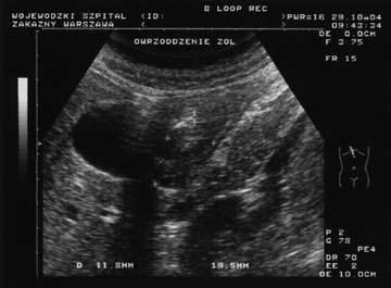 Pol J Radiol, 2006; 71(2): 31-41 The diagnostic value of transabdominal sonography... Figure 5. Chronic gastric ulcer disease.