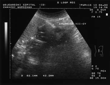 Original Article Pol J Radiol, 2006; 71(2): 31-41 Figure 9. Lymphoma of the stomach and duodenum in an HIV+ patient.