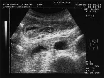 Pol J Radiol, 2006; 71(2): 31-41 The diagnostic value of transabdominal sonography... ubogoechogeniczny i wyraźnie odróżnia się od otoczenia (Ryc. 13, Ryc. 14).