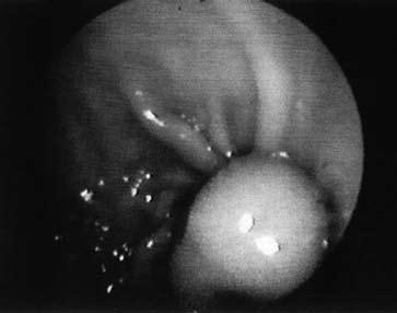 Wg Okanobu [10] czułość i specyficzność w gastropatii Ménétrier a, chłoniaku i raku wynosi 100%. W naszych przypadkach osiągnęliśmy niższy procent specyficzności tj. 88% (Tab.