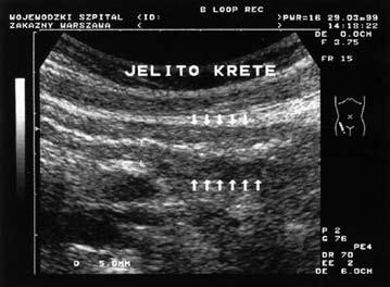 Original Article Pol J Radiol, 2006; 71(2): 31-41 (poza 2 przypadkami), które sugerowały zmiany jelita cienkiego. Badanie usg jelita cienkiego prowadziliśmy w sposób rutynowy tj.