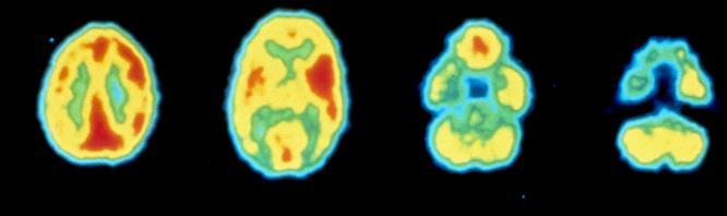 Cerebellum/Whole Brain Obniżenie