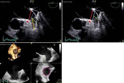 głębokość LAA w osi implantacji C Rycina 5. Schemat pomiarów uszka lewego przedsionka (LAA) w echokardiograii przezprzełykowej przed implantacją: A.