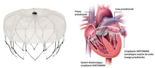 Przezcewnikowe zamykanie uszka lewego przedsionka A B Rycina 2. A. Urządzenie WATCHMAN; B. Zasada działania urządzenia WATCHMAN ilustracja zabiegu A B C D Rycina 3.