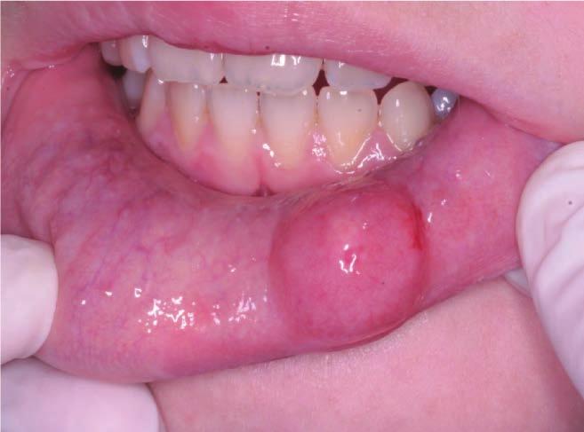 Torbiele małych gruczołów ślinowych u dzieci. Postępowanie chirurgiczne. Opis trzech przypadków klinicznych Mucous retention cysts of minor salivary glands in pediatric patients. Surgical procedures.