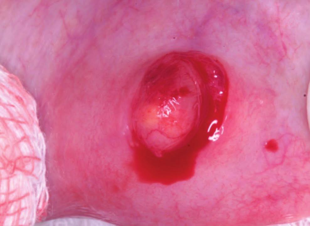 Ewa Krasuska-Sławińska, Tomasz Drewniak, Bogumiła Koeber Ryc. 3. Wyłuszczona torbiel in situ (przypadek 1) Fig. 3. Removed in situ cyst (case 1) Ryc. 4.