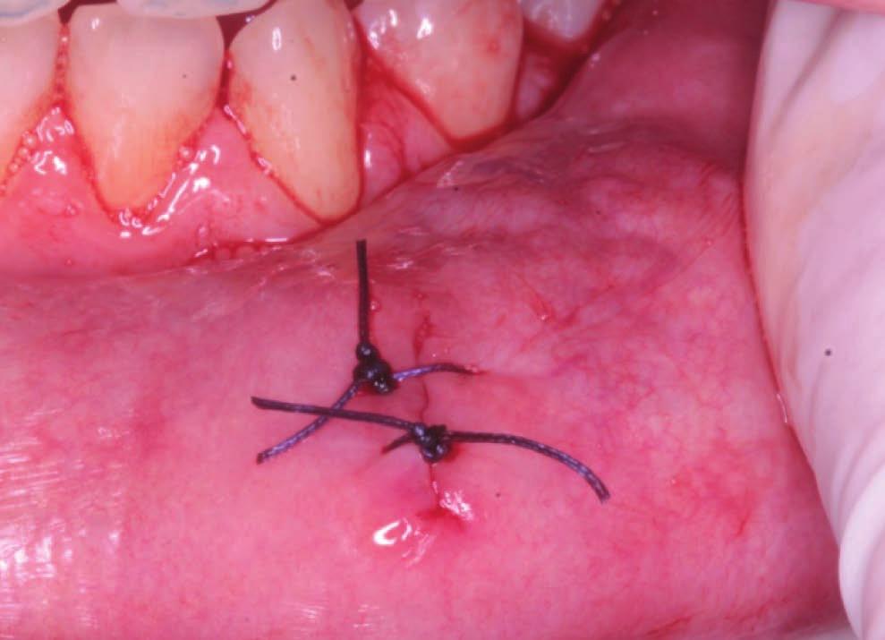 Torbiele małych gruczołów ślinowych u dzieci. Postępowanie chirurgiczne. Opis trzech przypadków klinicznych Mucous retention cysts of minor salivary glands in pediatric patients. Surgical procedures.