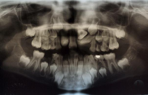 o rto d o n c ja Leczenie ortodontyczno-chirurgiczne musi być dokładnie zaplanowane i poprzedzone skrupulatną diagnostyką radiologiczną zdjęciem pantomograficznym oraz tomografią stożkową (CBCT)