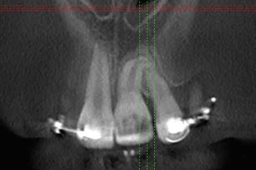 o rto d o n c ja 8 9 Fot. 8. Skan CBCT. Stan obecny Fot. 9. Zdjęcie 3D z wykorzystaniem CBCT po wprowadzeniu zębów 21 i 22 do łuku zębowego z zębów mlecznych na stałe zgodnie z okresem fizjologicznej wymiany uzębienia.