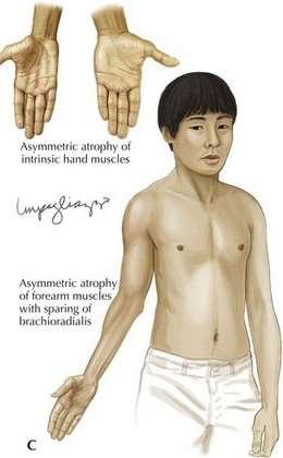 Zespół Hirayama Inne nazwy: Młodzieńczy odsiebny rdzeniowy zanik mięśni kończyny górnej Monomelic muscular atrophy Monomelic amiotrophy Zwykle