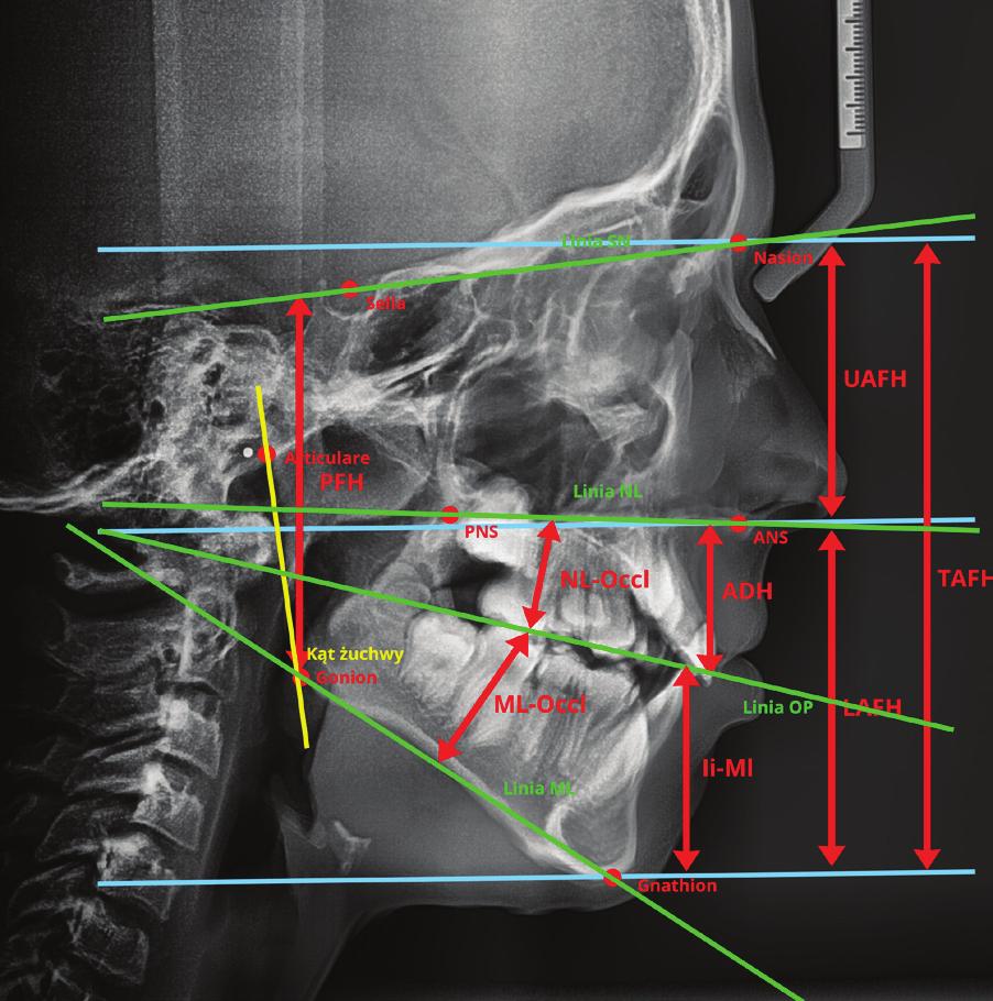 Aetiology and diagnostics of Long Face Syndrome based on literature J Stoma 2015; 68, 5 PNS) and on a clinical examination it manifests itself as excessive exposure of the upper incisors and gingivae