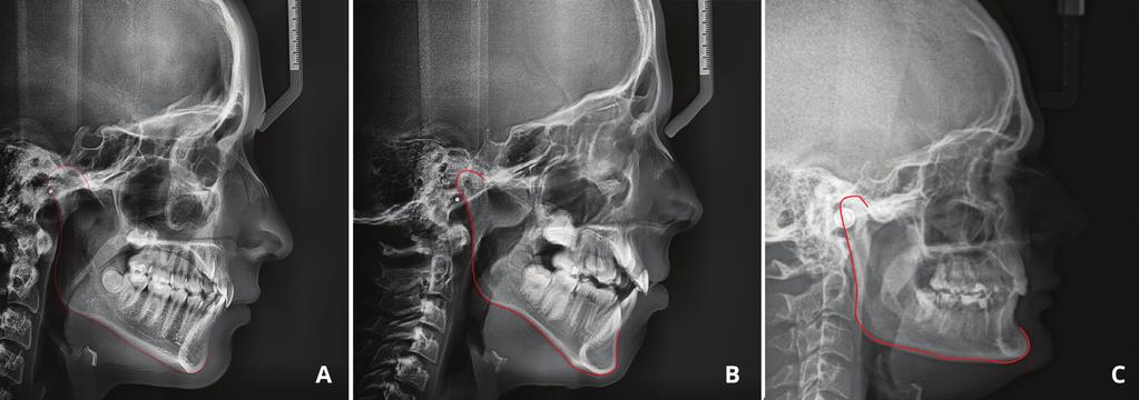 J Stoma 2015; 68, 5 Sobieska E., Fester A., Ciok E., Zadurska M. Fig. 5. A typical shape of the mandible in a patient: A with a normal bite, B with the long face syndrome, C with a short face syndrome.