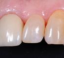 Mackenzie L, Parmar D, Shortall ACC, Burke FJT. Direct anterior composites: a practical guide. Dental Update. 2013 May; 40(4):297-308 2.