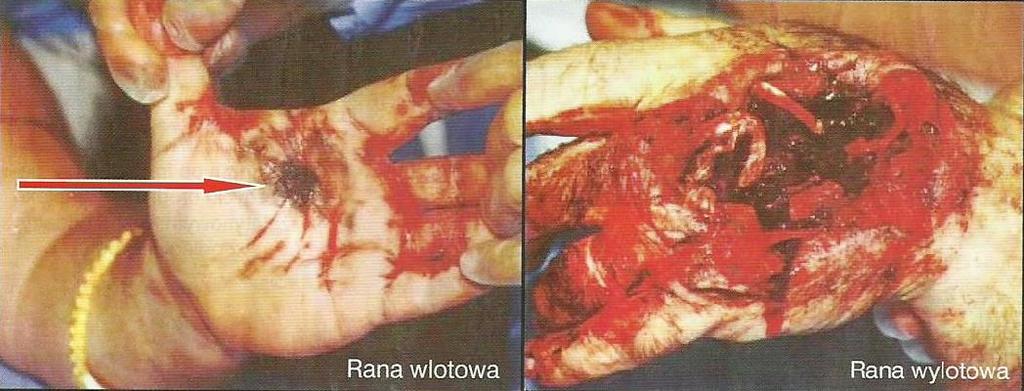 Postrzały ślepe, czyli takie, które posiadają tylko otwór wlotowy, są najczęstszym rodzajem postrzałów ze względu na duże odległości na jakich prowadzone są walki.