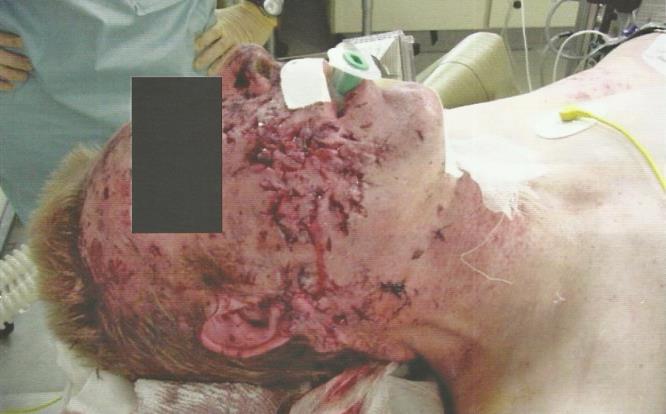 Rany powstałe na skutek detonacji to kolejne najczęstsze obrażenia zagrażające życiu żołnierzy.