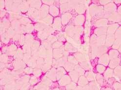 Choroba Pompego Postępująca miopatia metaboliczna (MIM #232300) spowodowana niedoborem kwaśnej α-1,4-