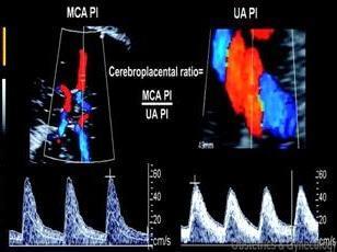 Cruz-Martinez et al. Longitudinal brain perfusion changes in near-term SGA fetuses as mesured by spectral Doopler indices. Am. J Obstet Gynecol 2010.