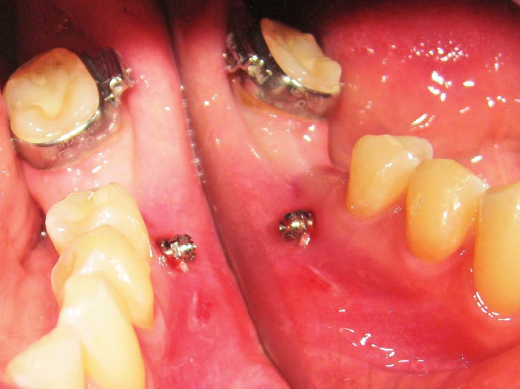 ORTODONCJA W PRAKTYCE 1/2017 3a Ryc. 3a. Miniimplant (dł. 6 mm, śr.