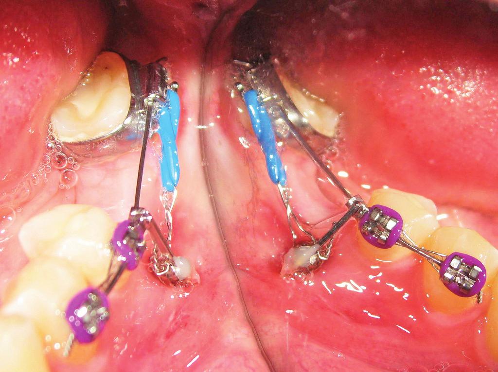 3b Ryc. 3b. Miniimplant (dł. 6 mm, śr.