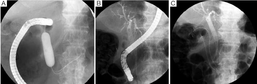 Maetani I. Self-expandable metallic stent placement for palliation in gastric outlet obstruction.