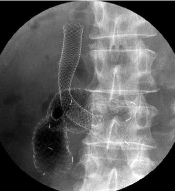 Maetani I. Self-expandable metallic stent placement for palliation in gastric outlet obstruction.