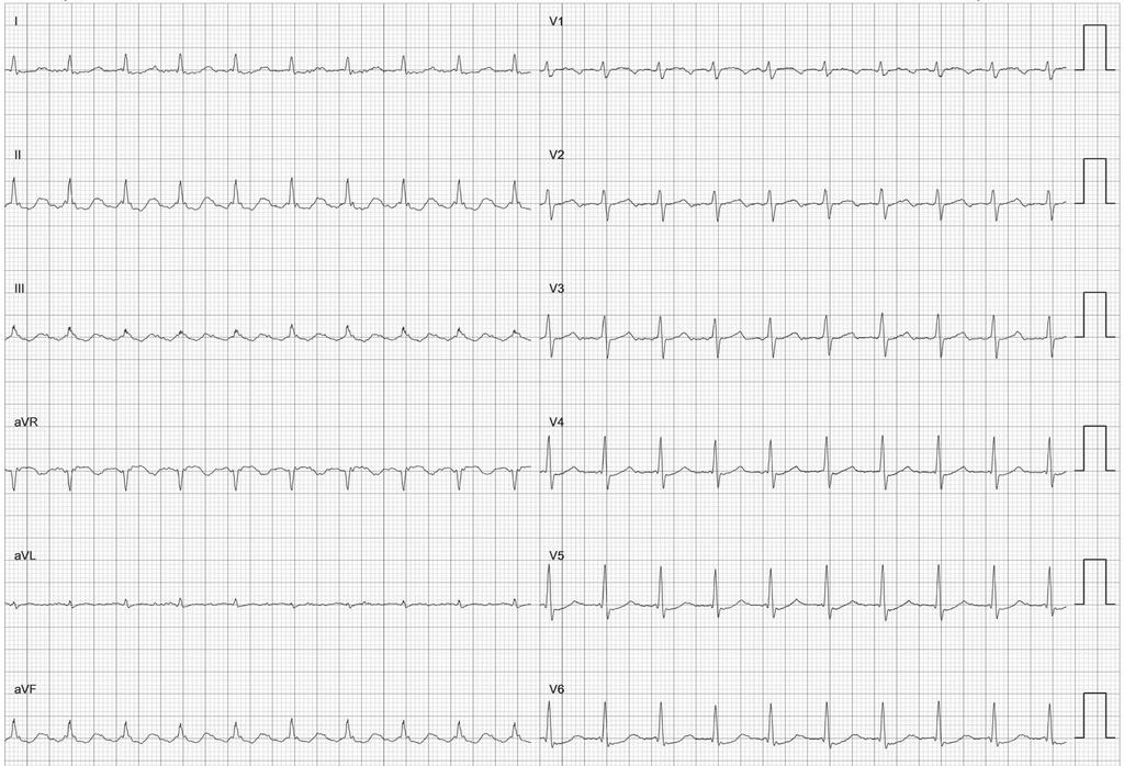 12-lead ECG of atrial flutter recorded before first ablation Rycina 5.
