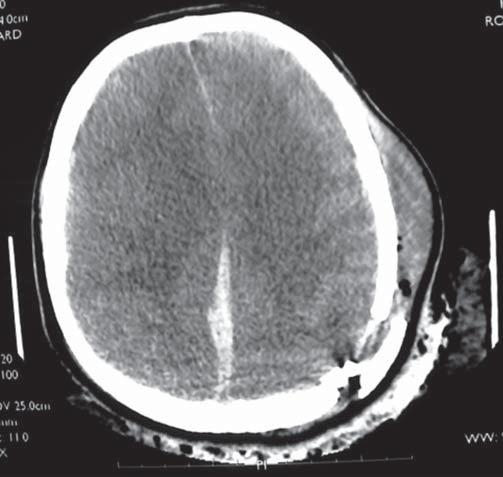 datowanie radiografii udaru niedokrwiennego mózgu jestem tylko przystawką lub więcej