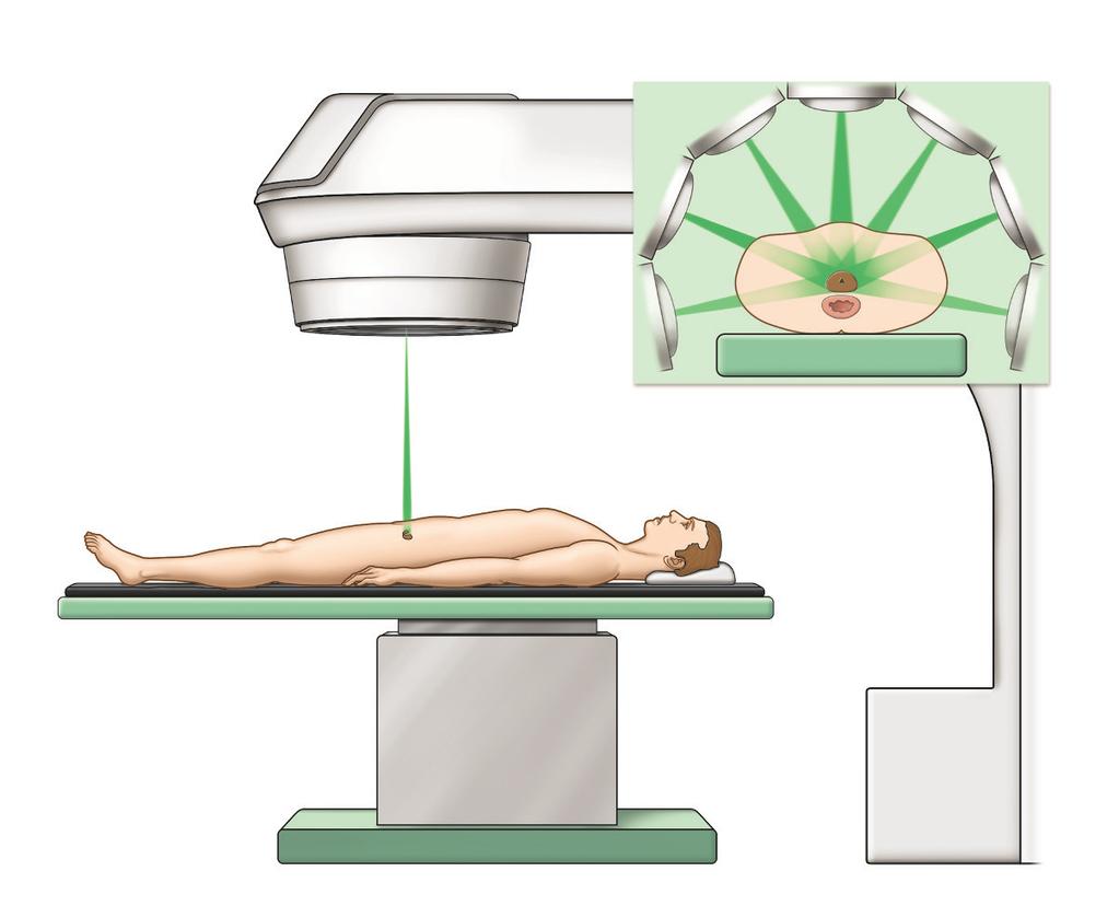 Radioterapia Radioterapia uszkadza i niszczy komórki nowotworowe. Leczenie promieniami można stosować na jeden z dwóch sposobów: zewnętrznie lub wewnętrznie (brachyterapia).